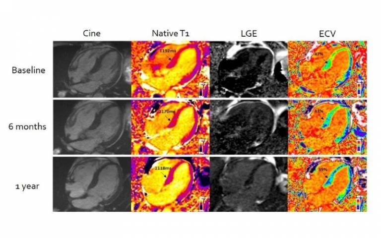 MRI with CMR (T1) & ECV mapping