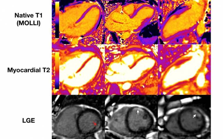MRI highlighting myocardial injury in COVID-19 patient