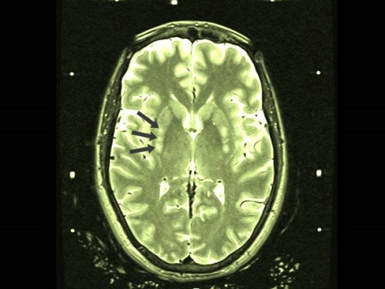 MRI scan of brain with arrows identifying where gene therapy was injected