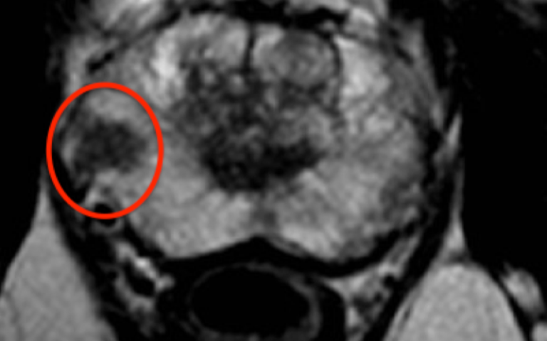 MRI scan of prostate