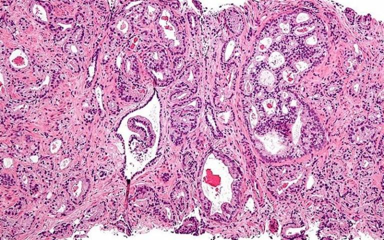 Prostate cancer cells