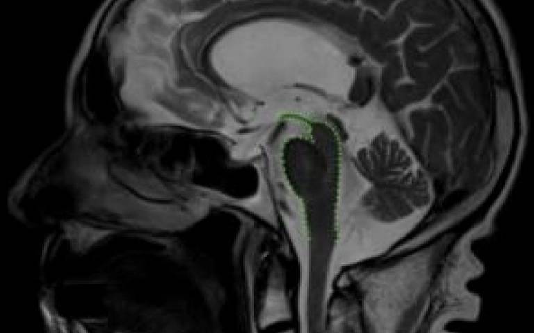 scan highlighting area of midbrain atrophy, characteristic of PSP