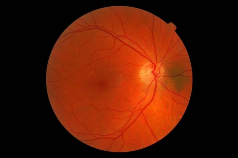 Blood vessels visible in the retina