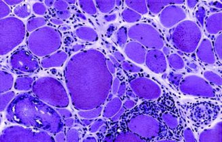 Cross-section of muscle from a patient with inclusion body myositis (courtesy of Marinos C. Dalakas MD via Neurology)