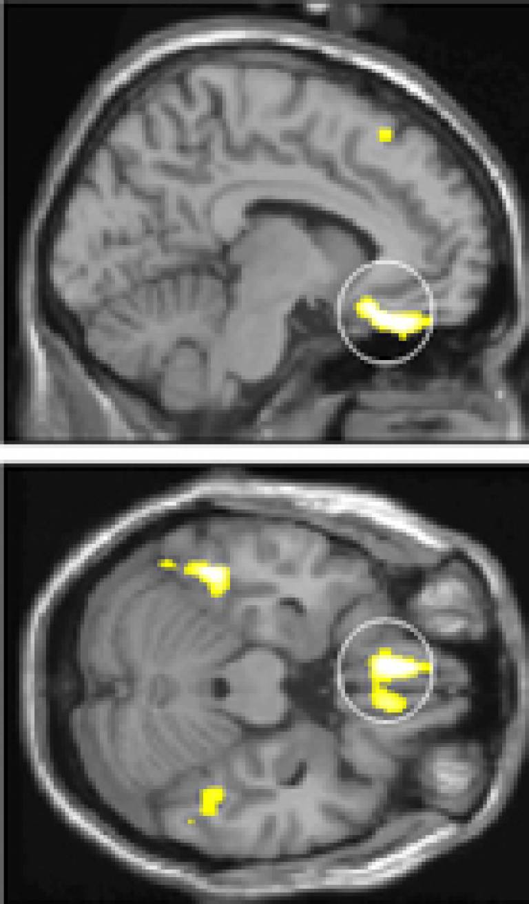 PCM1 brain scan