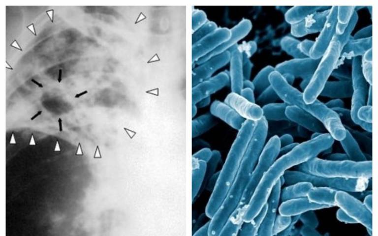 TB is an infection caused by the bacterium Mycobacterium tuberculosis 