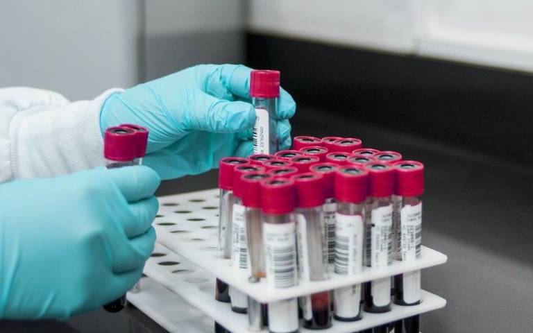 Biomarker test can predict which cancer patients are most likely to relapsee
