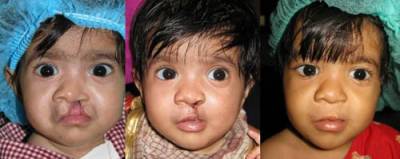A child before and after a cleft palate operation