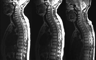 mri sclerosis ucl disability predict