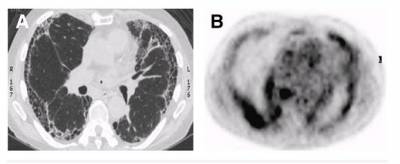 Parenchymal honeycombing on HRCT (A) with associated intense 18F-FDG uptake (B).