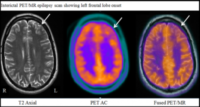 Interictal PET/MR epilepsy scan showing left frontal lobe onset