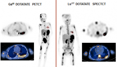 Molecular Radiotherapy Dotatate