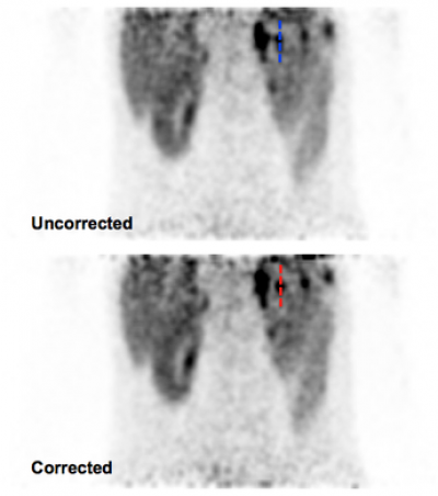 Respiratory Motion Corrected images through a pancreatic lesion