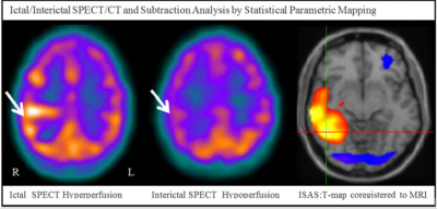 Ictal/Interictal SPECT/CT and subtraction analysis by statistical parametric mapping