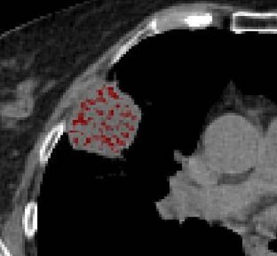 Lung carcinoma of relatively homogenous texture on CT