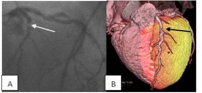 82-Rb cardiac hybrid PET CT imaging