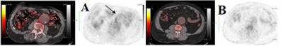 Fused FDG PET/CT and black and white PET images