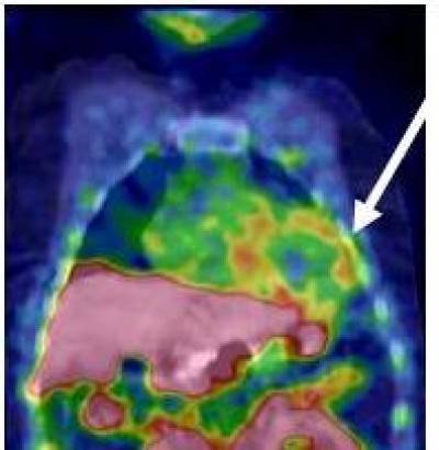 The SPECT/CT image shows the biodistribution and myocardial uptake of the angiogenesis ligand
