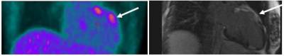 Anterobasal Myocardial uptake of uptake of FDG confirmed on cardiac MRI