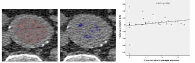First study measuring heterogeniety of aortic aneurysms using CT textural analysis
