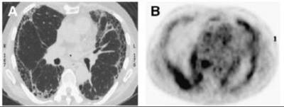 Idiopathic pulmonary fibrosis is a fibrotic lung disease