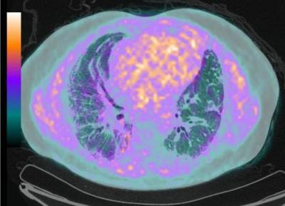 PET image fused to CT, from a patients with idiopathic pulmonary fibrosis using FMISO a hypoxia tracer