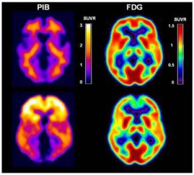 Alzheimer’s disease PET images