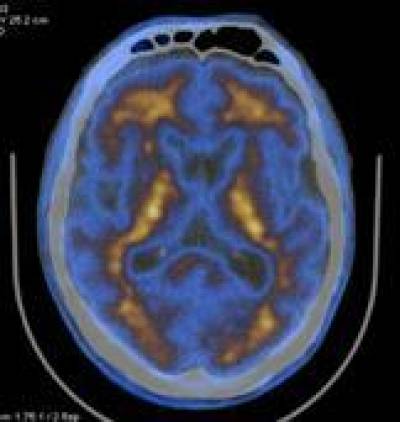 Image from the 1st UCLH use of a beta amyloid PET ligand.