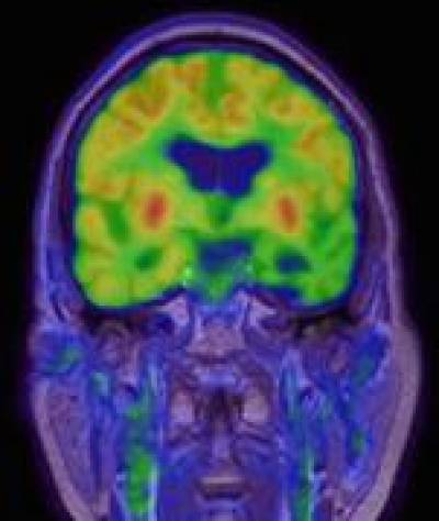 Semantic Dementia : FDG PET Fused to Coronal MPRAGE MR sequence