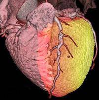 Fused cardiac PET/CT