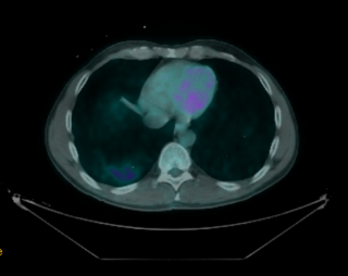 PET CT Lung Cancer