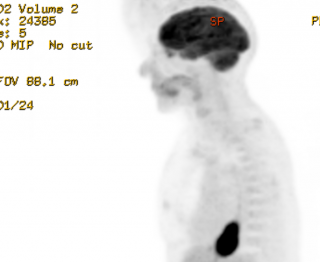 PET CT upper GI cancer MIP