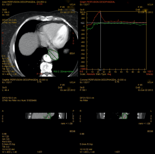 CT perfusion images of oesophageal cancer