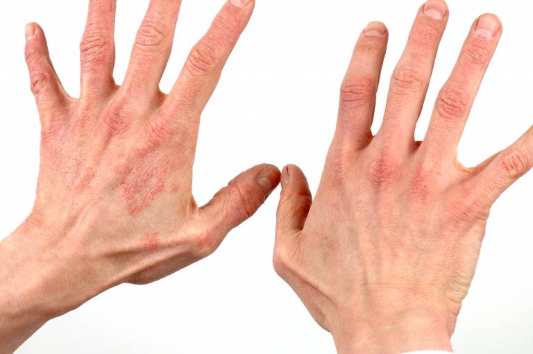 Dermatitis showing reddening of skin