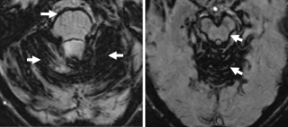 Haemosiderin appearance as dark areas and rims over cerebellum and brainstem