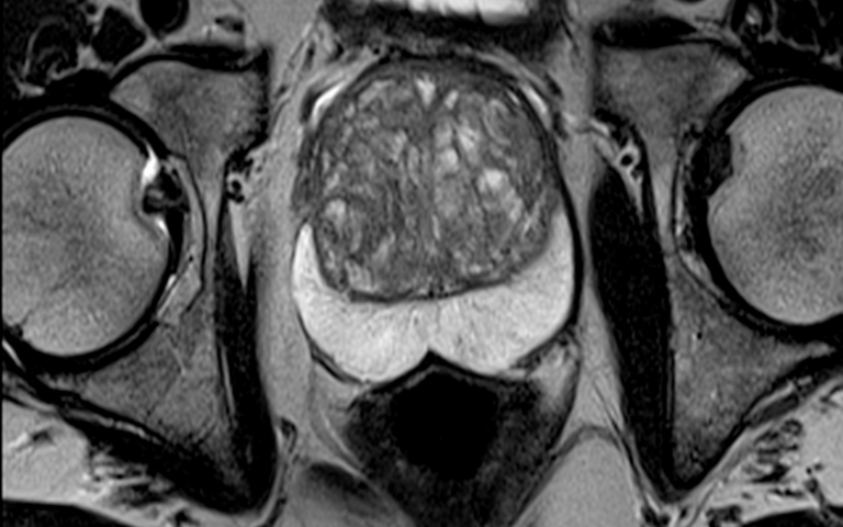 A mágneses rezonanciás vizsgálat (MRI) szerepe prosztatarák megítélésében