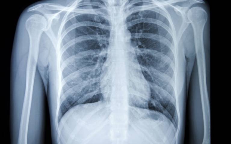 Xray image of a chest