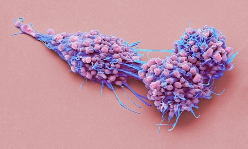 Coloured scanning electron micrograph of ovarian cancer cells. Picture courtsey of Stephen Gschmeissner