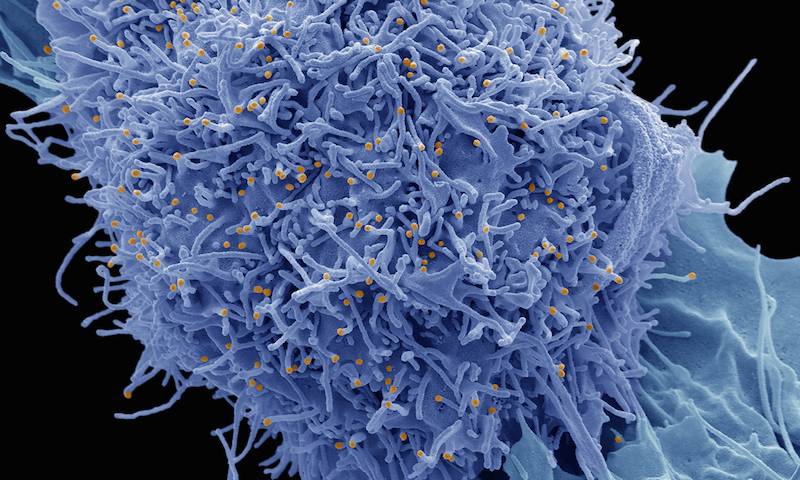 False coloured SEM image of Herpes Simplex infected 283T cells in culture. Image is copyrighted. It was taken on SEM by Steve Gschmeissner. To see more of his work, visit http://theworldcloseup.com/