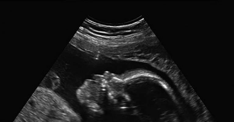 Ultrasound of baby in womb